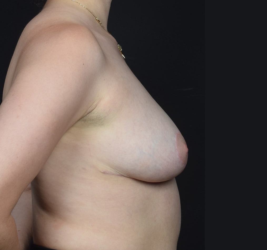 Patient 39 gallery after e