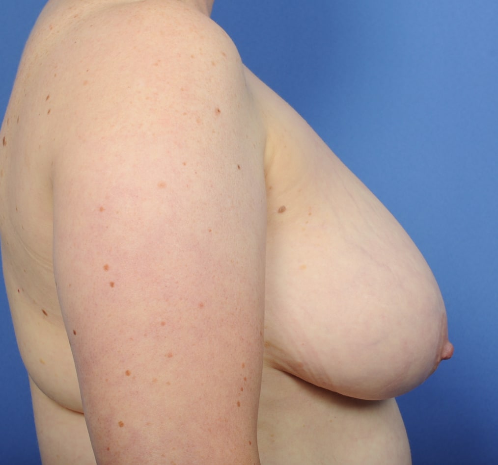 Patient 47 gallery before e