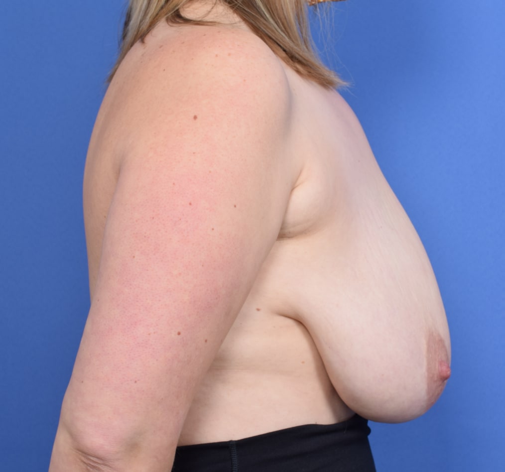 Patient 48 gallery before e