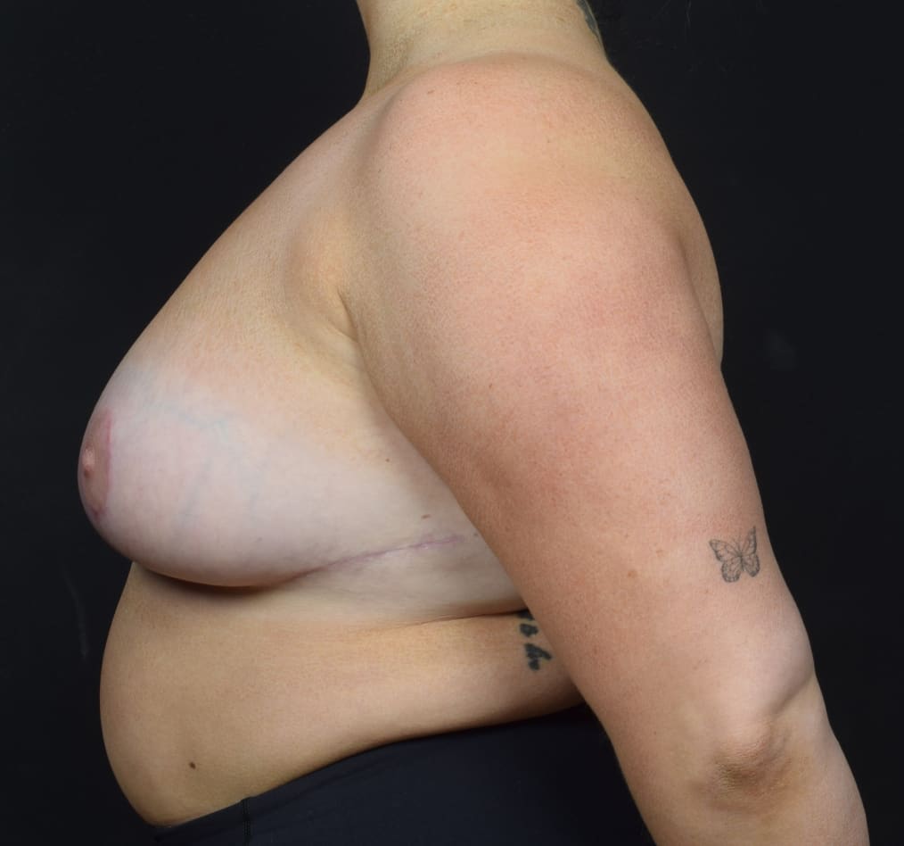 Patient 49 gallery after d