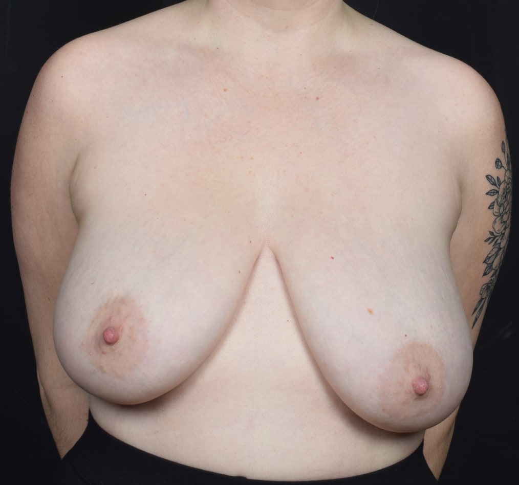 Patient 52 gallery before a