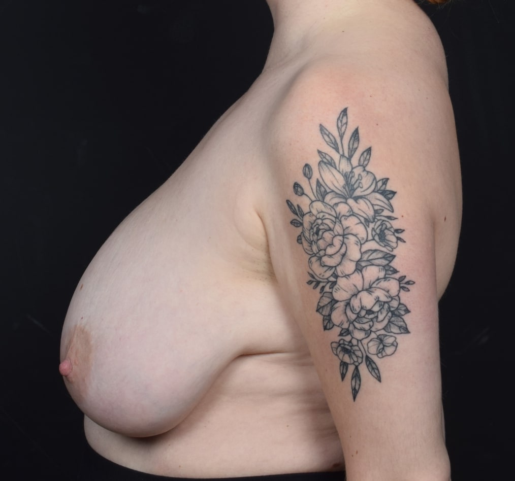 Patient 52 gallery before d