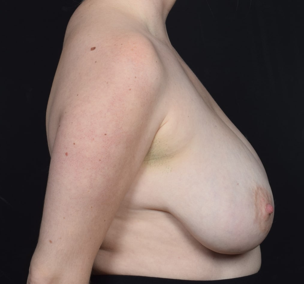 Patient 52 gallery before e