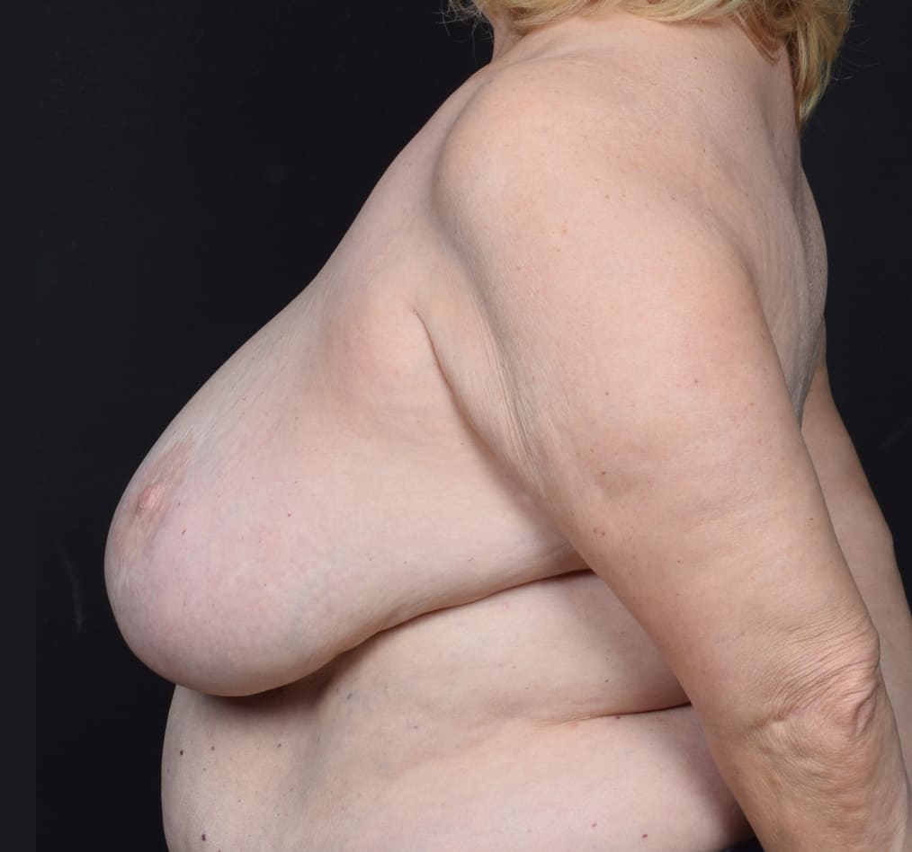 Patient 55 gallery before d