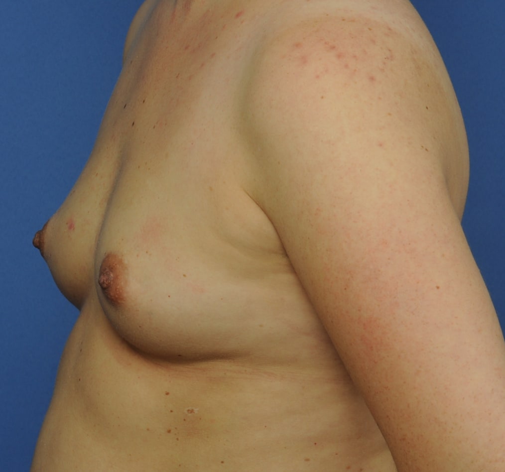 Patient 101 gallery before b