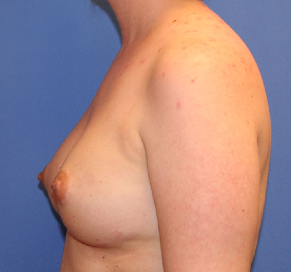 Patient 101gallery after d