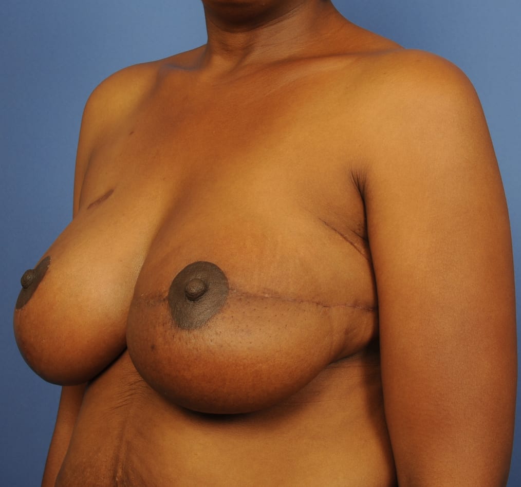 Patient 102 gallery after b