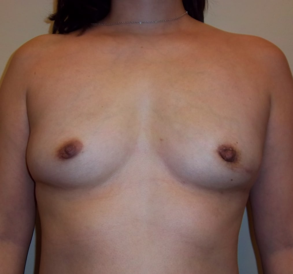 Patient 103 gallery after a