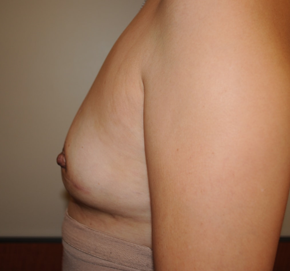 Patient 103 gallery after d