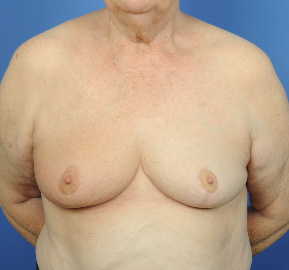 Patient 88 gallery after a