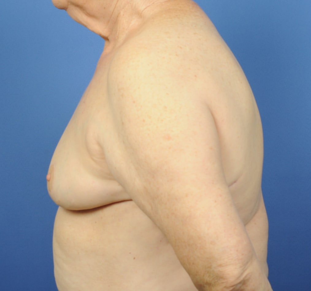 Patient 88 gallery after d