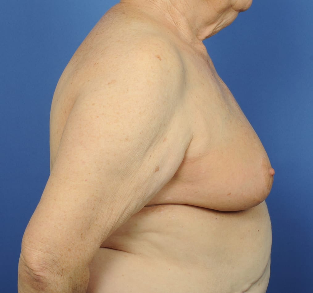 Patient 88 gallery after e