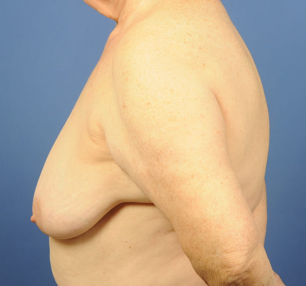 Patient 88 gallery before d