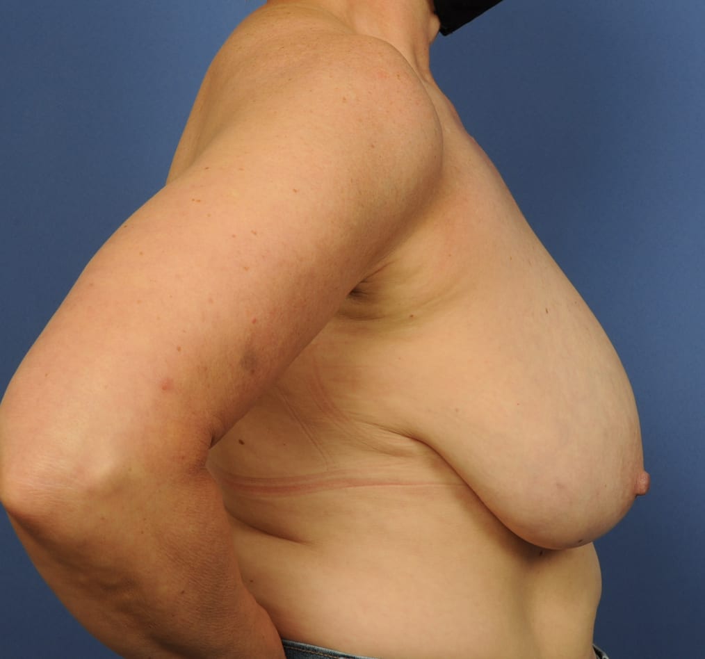 Patient 91 gallery before e