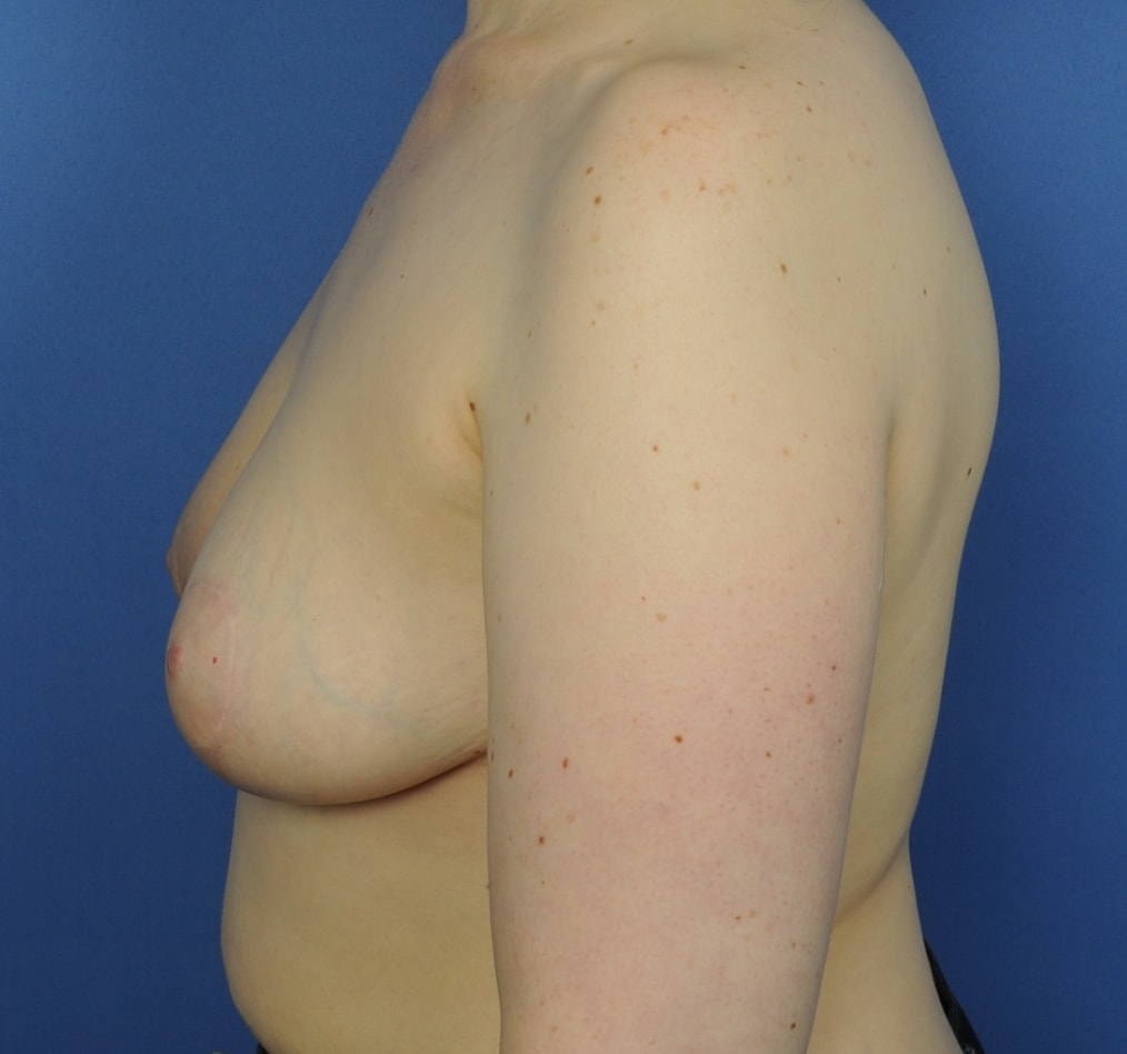 Patient 92 gallery after d