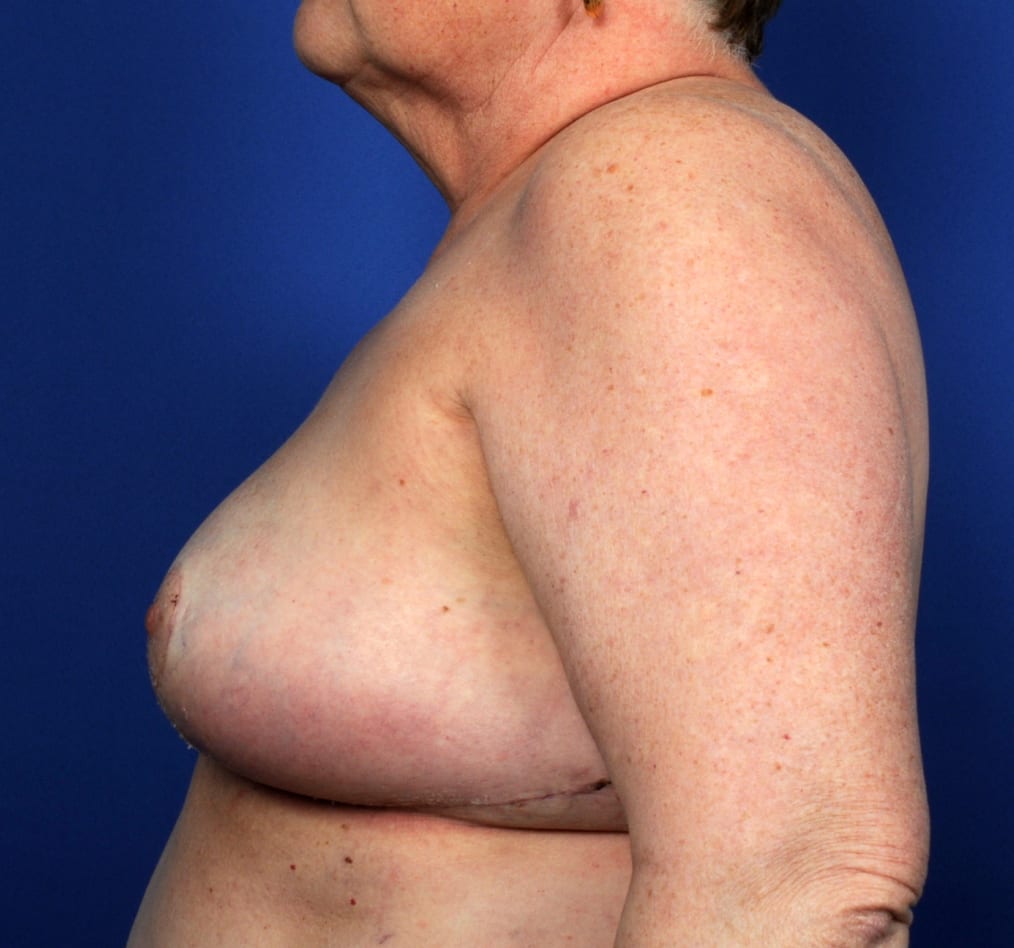 Patient 93 gallery after d