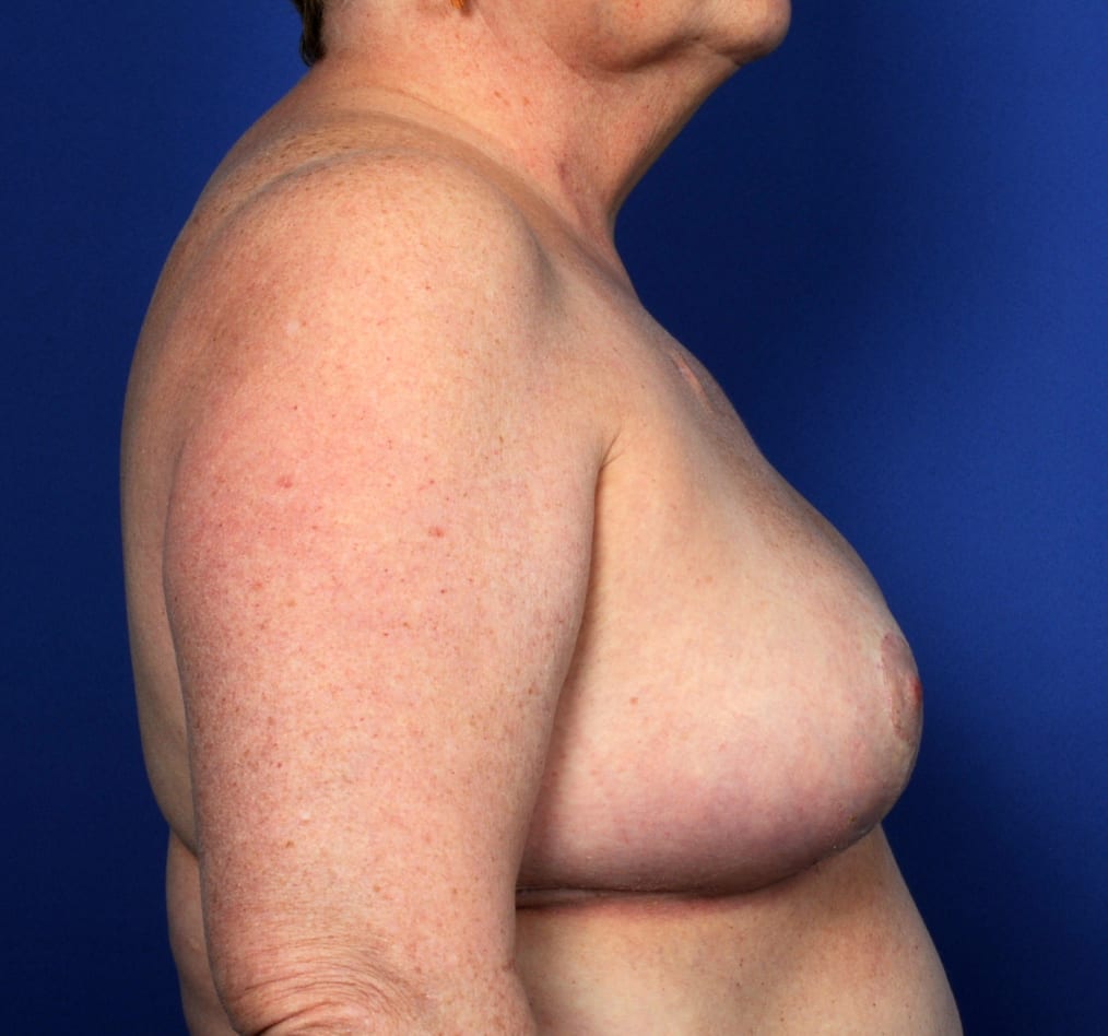 Patient 93 gallery after e