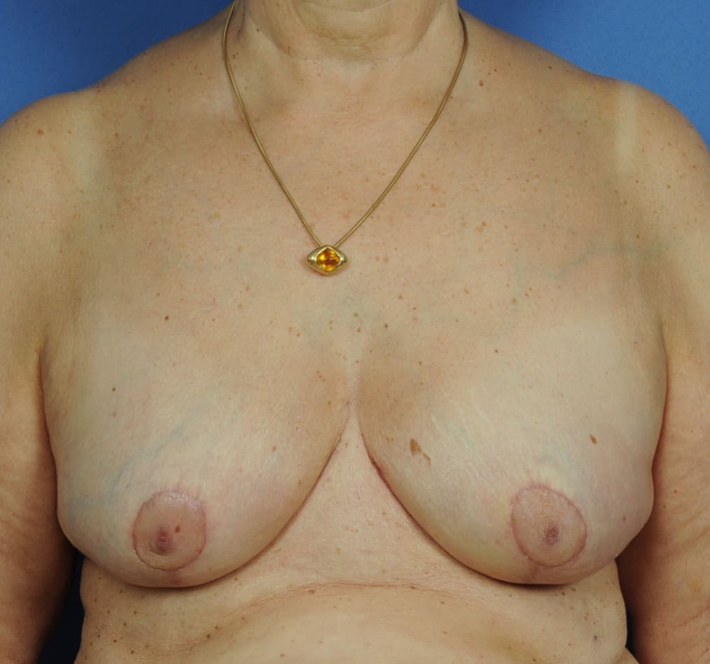 Patient 94 gallery after a