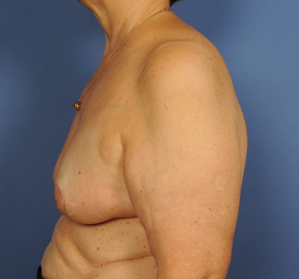 Patient 94 gallery after d