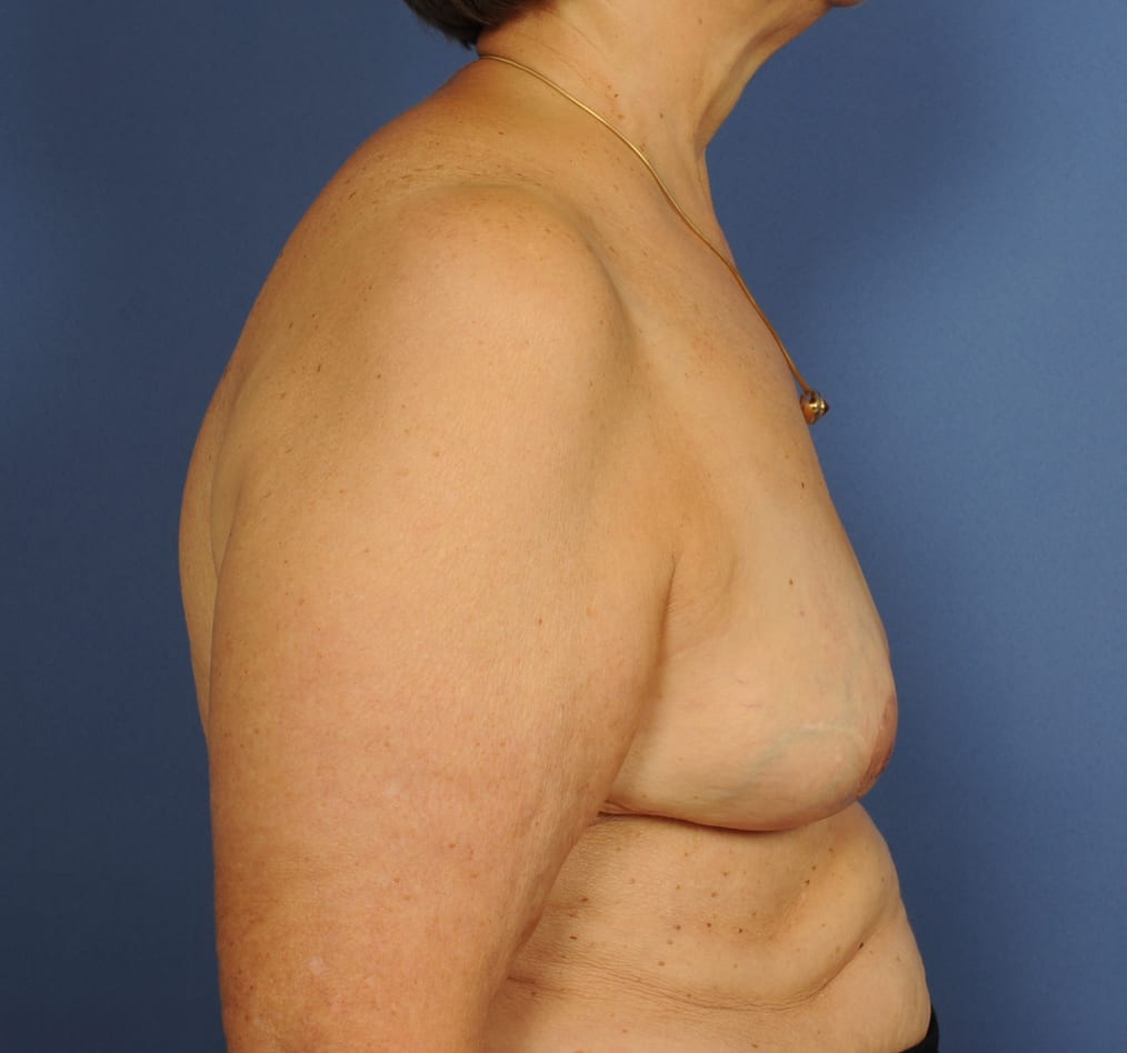 Patient 94 gallery after e