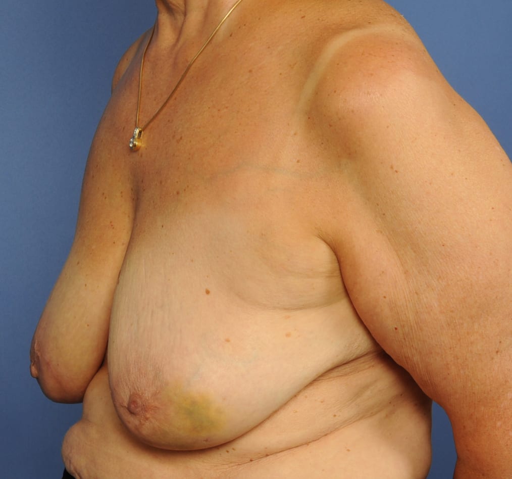 Patient 94 gallery before b