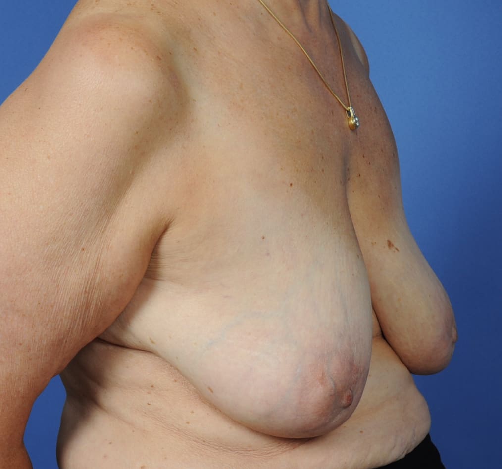 Patient 94 gallery before c