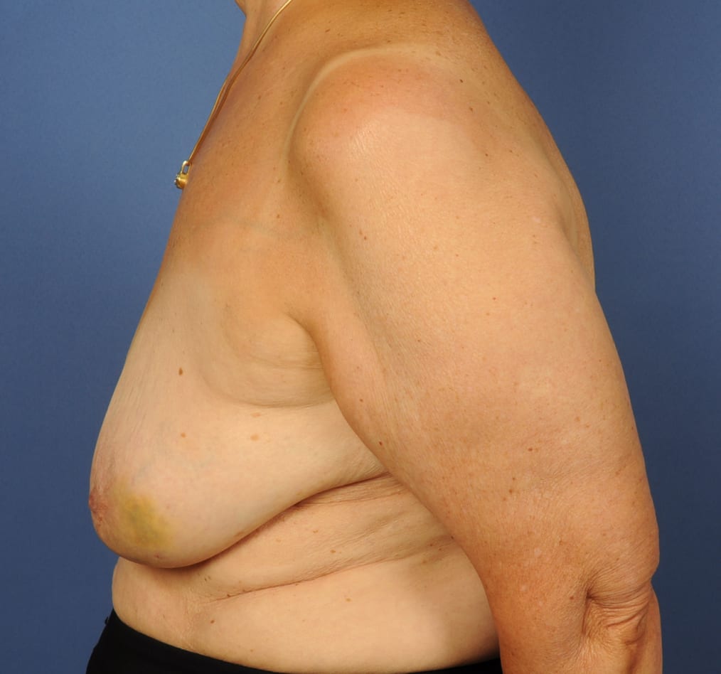 Patient 94 gallery before d