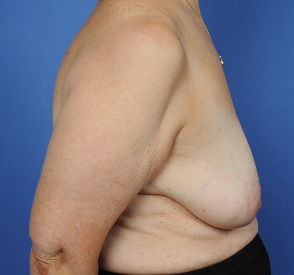 Patient 94 gallery before e