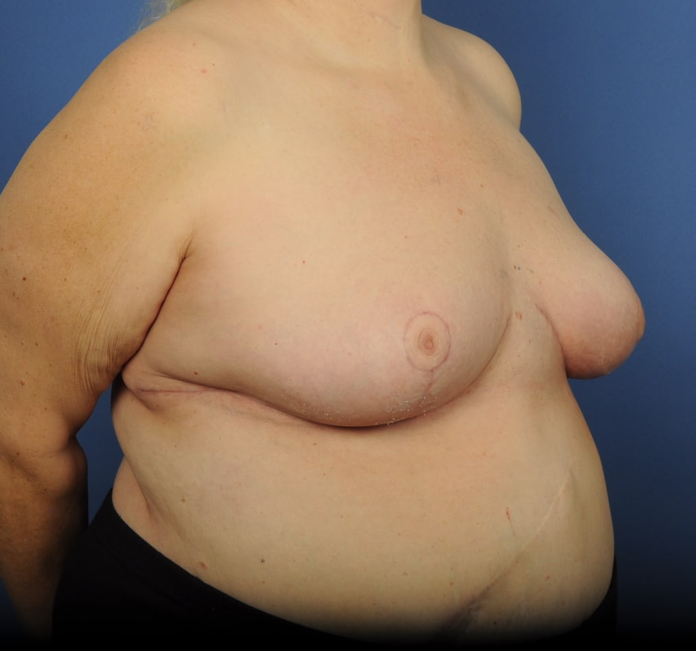 Patient 95 gallery after c