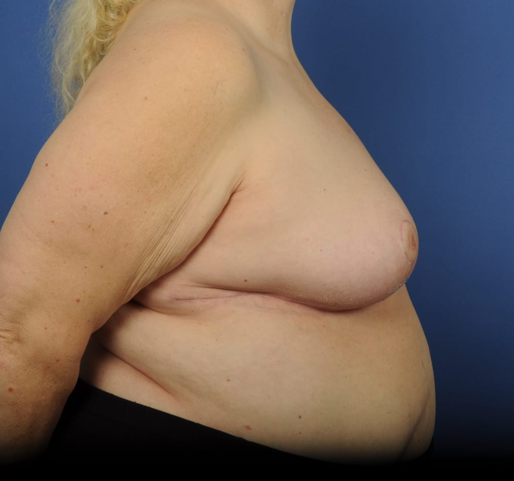 Patient 95 gallery after e