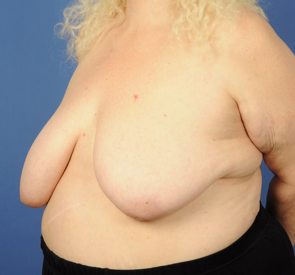 Patient 95 gallery before b