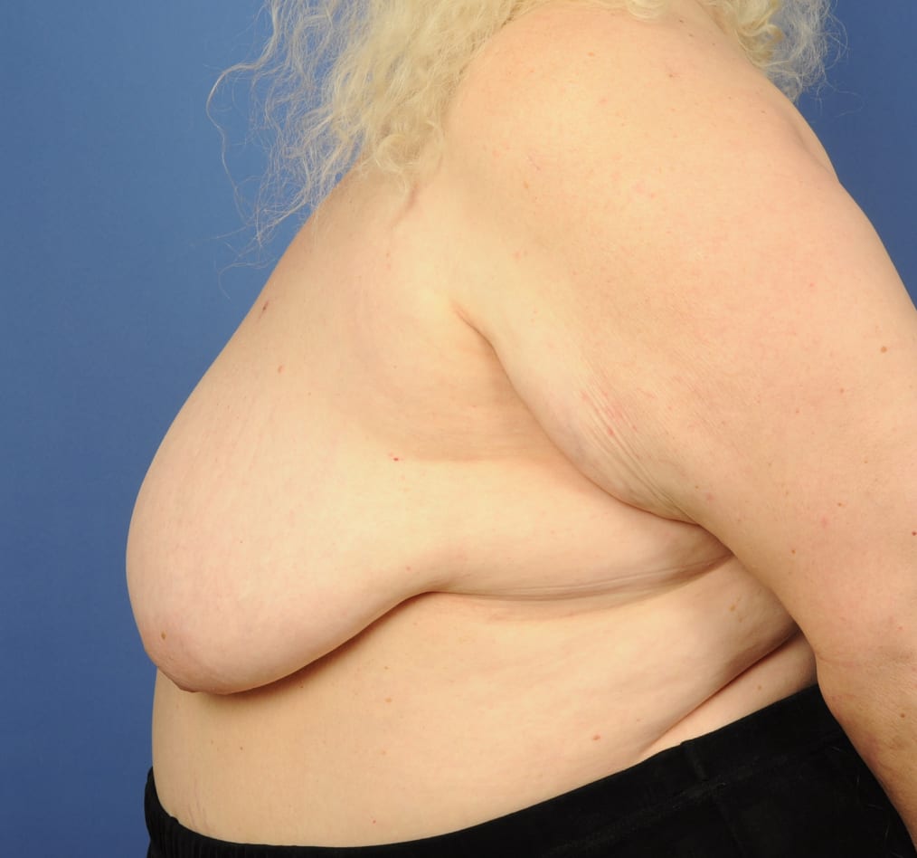 Patient 95 gallery before d