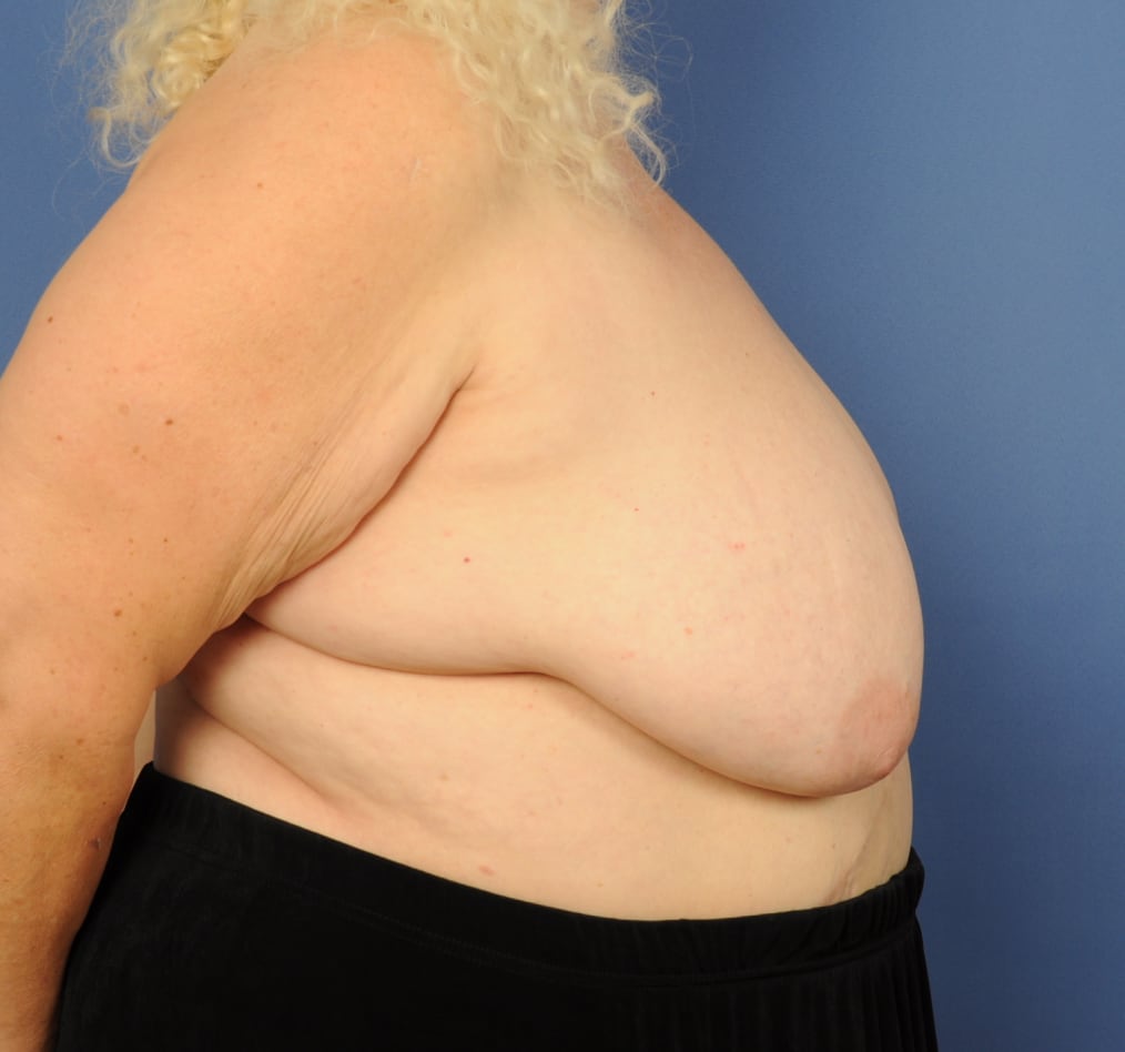 Patient 95 gallery before e