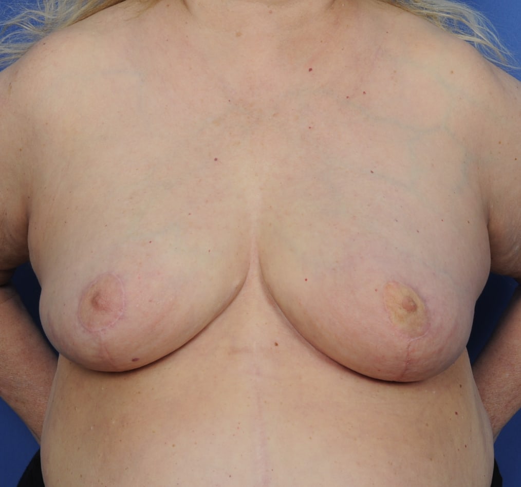 Patient 96 gallery after a