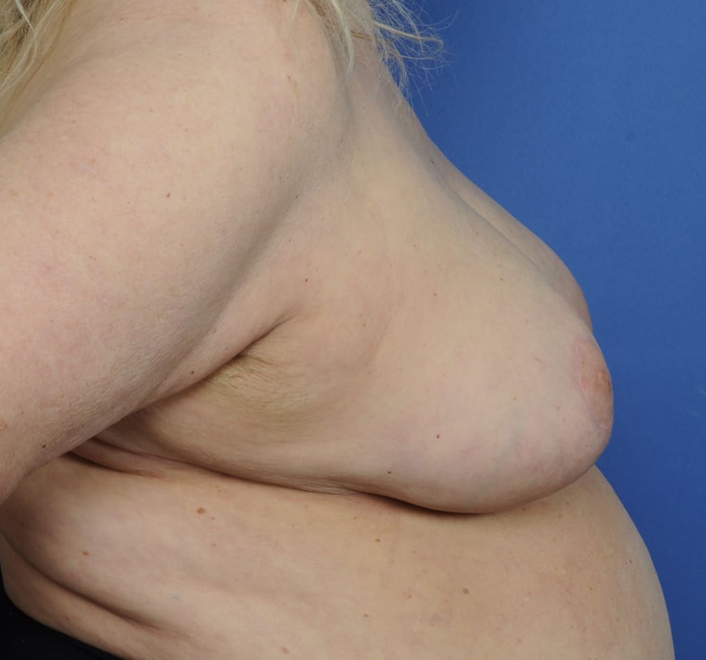 Patient 96 gallery after e