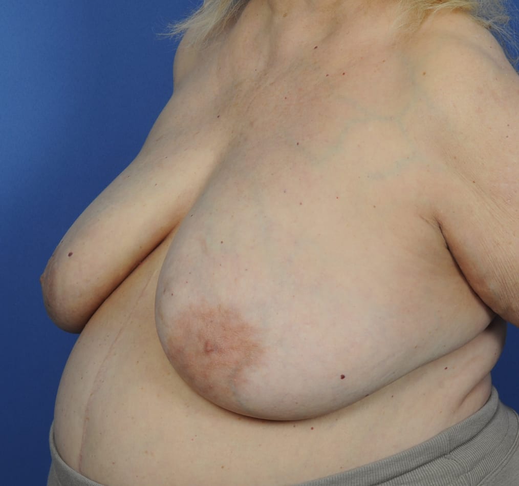 Patient 96 gallery before b