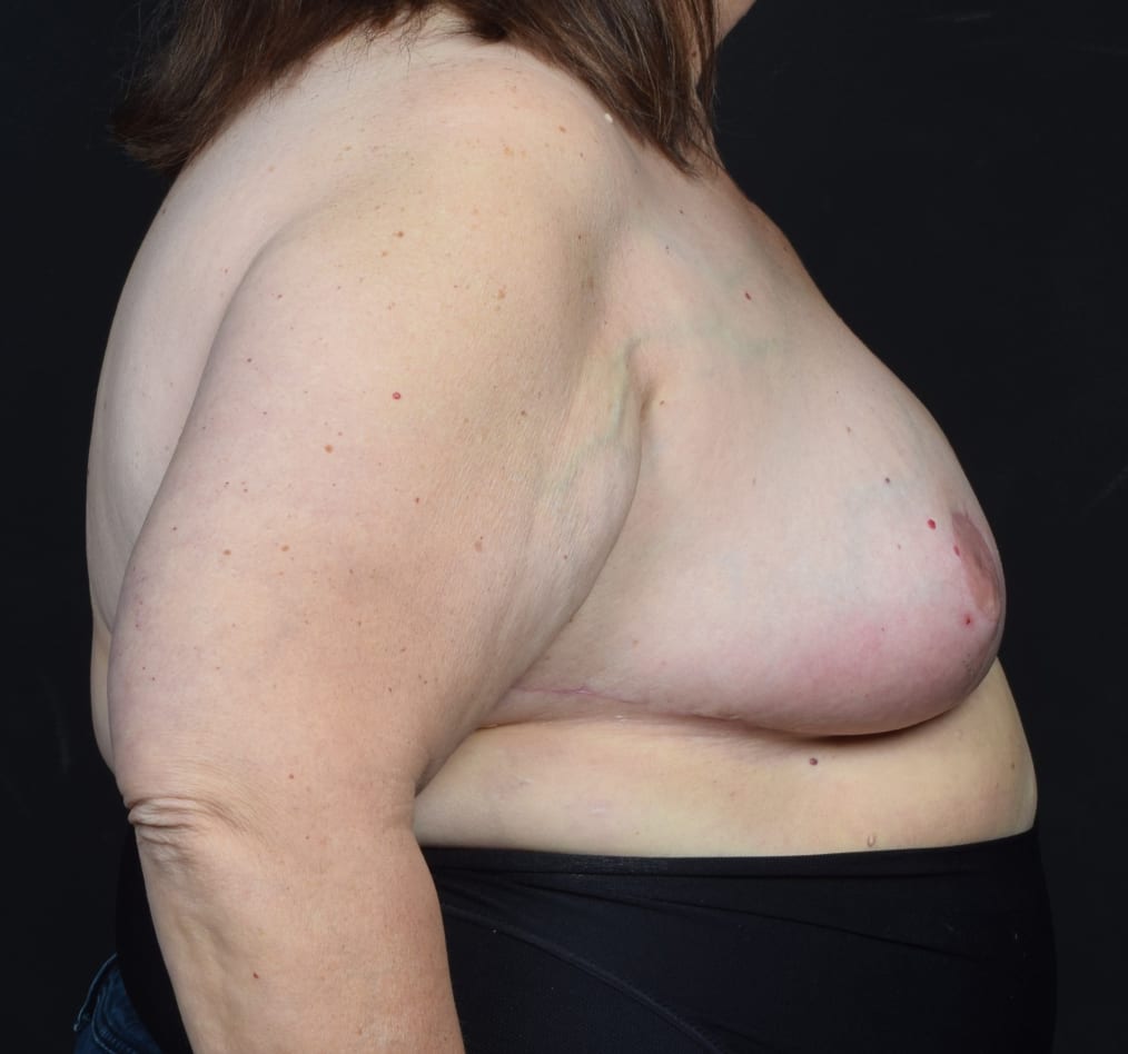 Patient 98 gallery after e