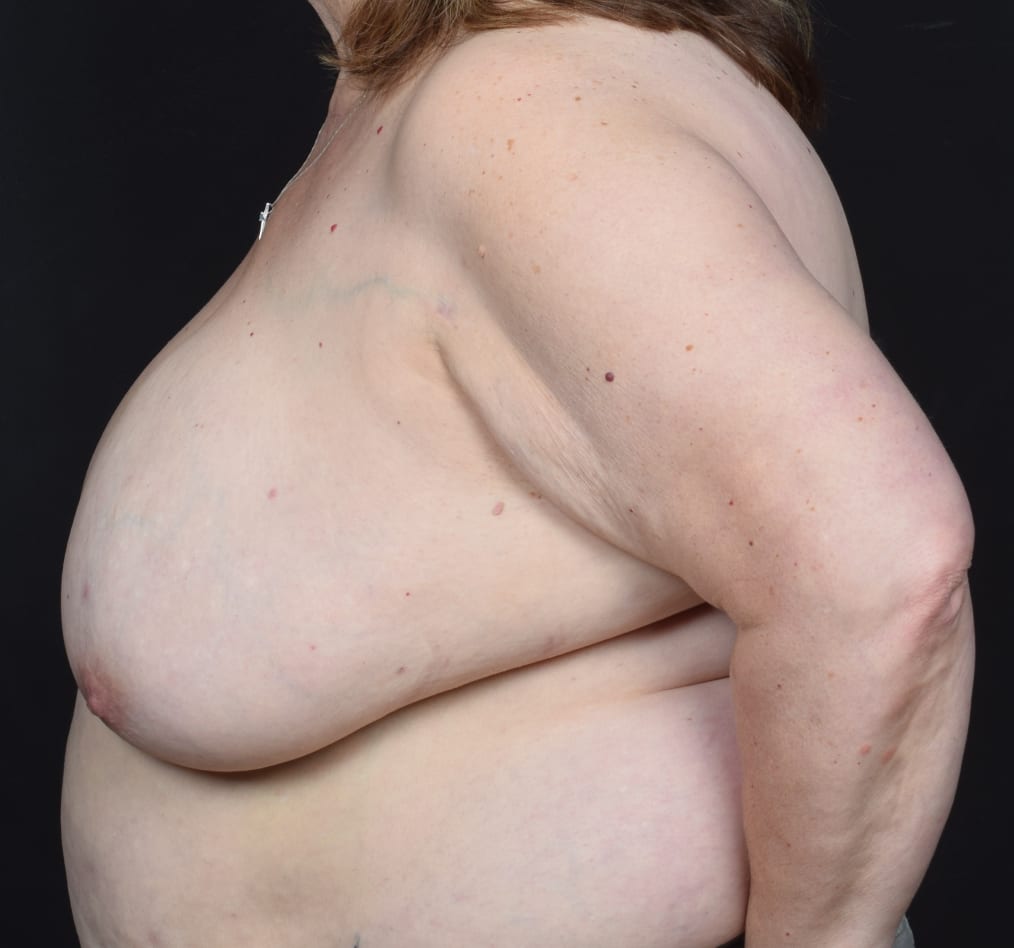 Patient 98 gallery before d