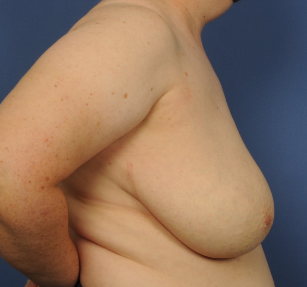 Patient 99 gallery before e