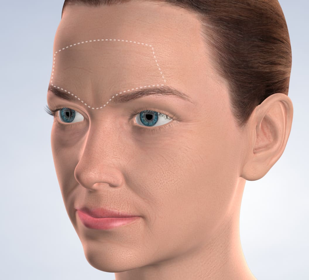 Query  botox