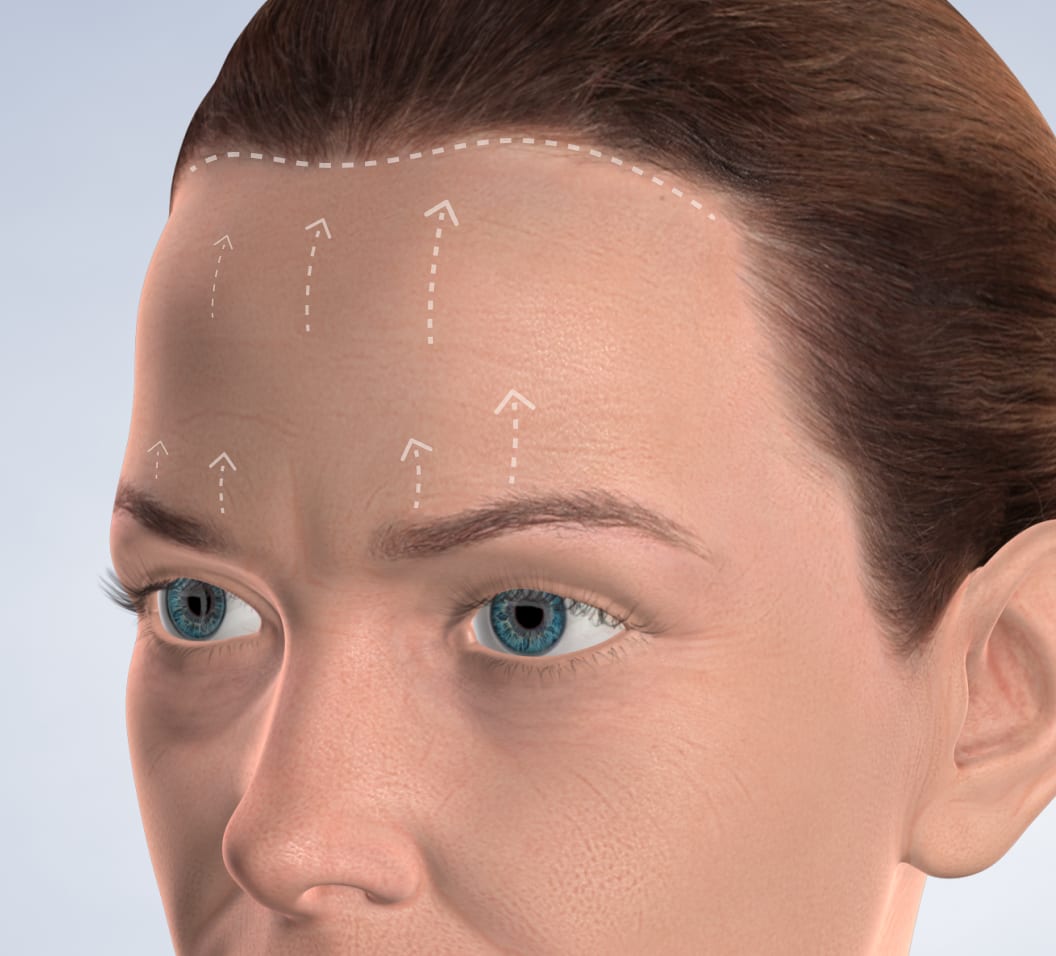 Query  brow forhead surgery