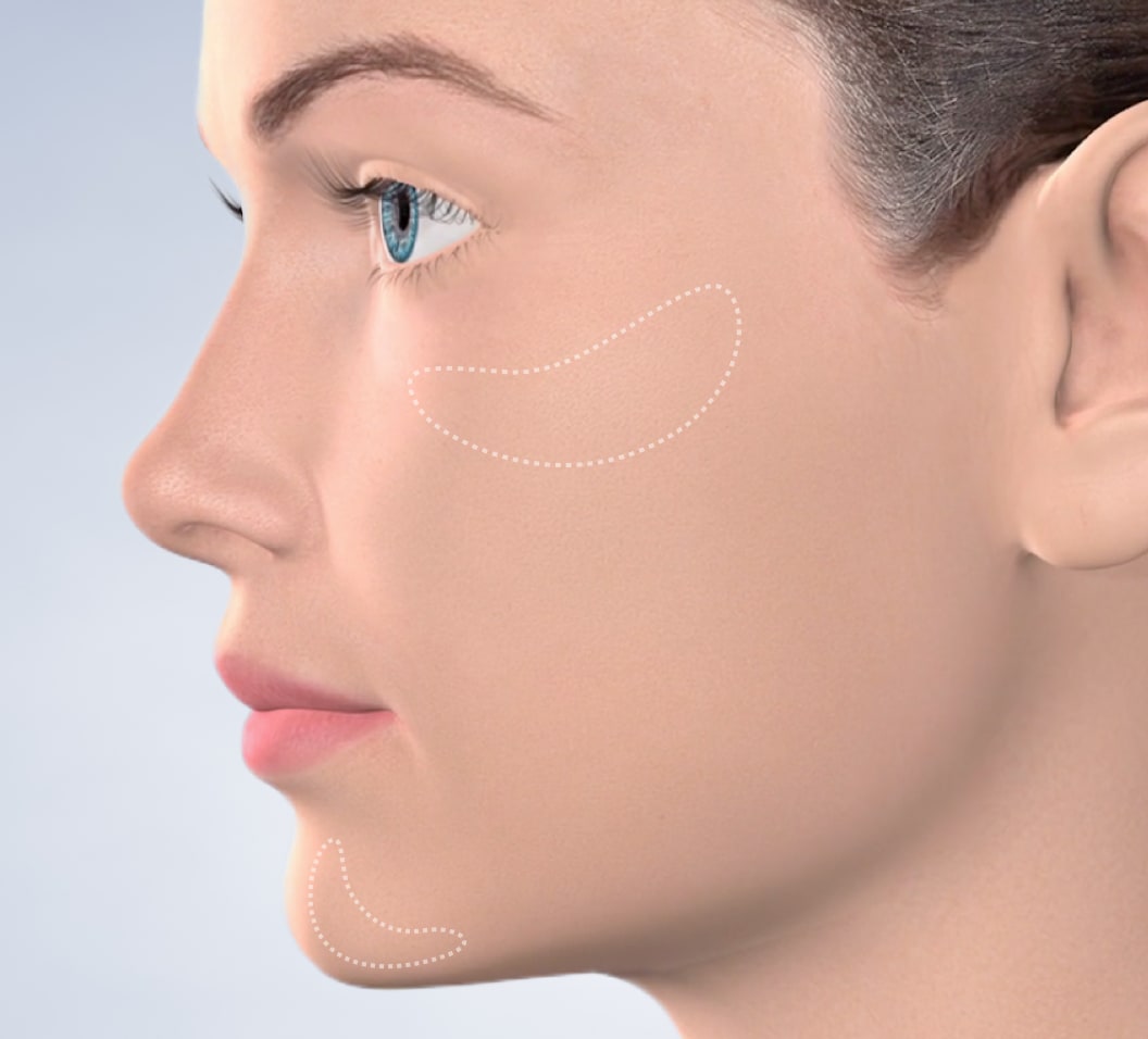 Query  chin surgery