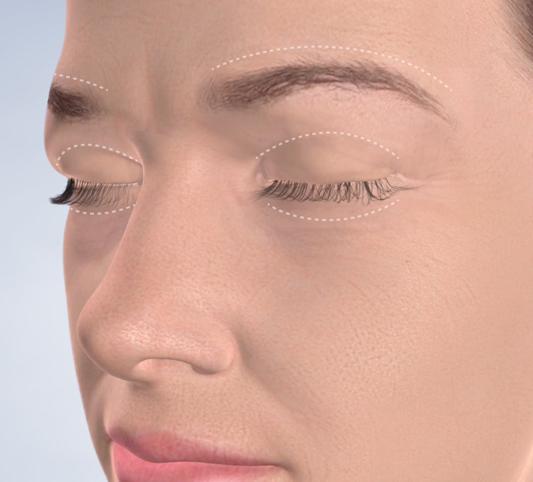 Query  eyelid surgery