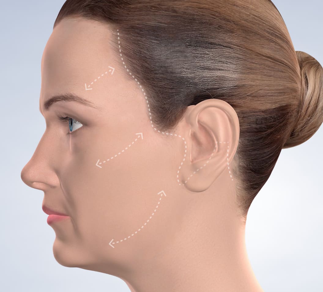 Query  facelift