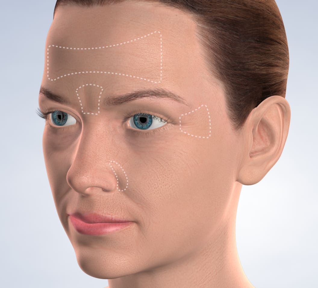 Query  botox for tmj