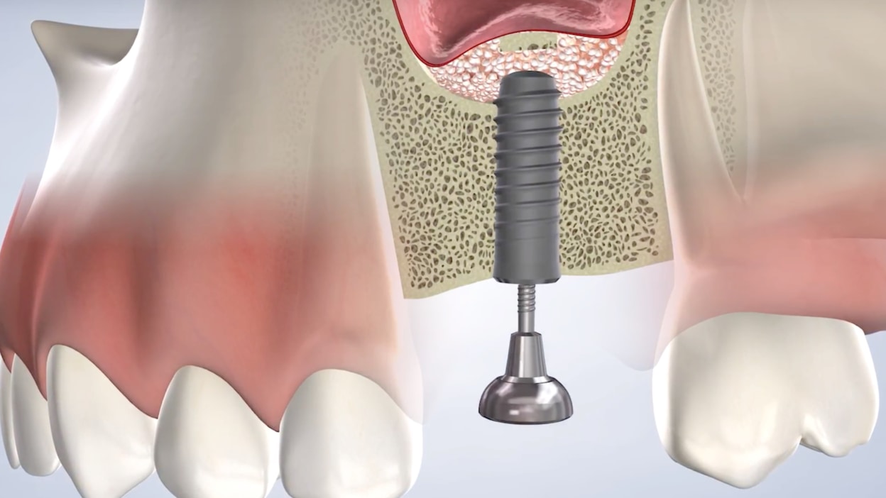 Instructions bone grafting