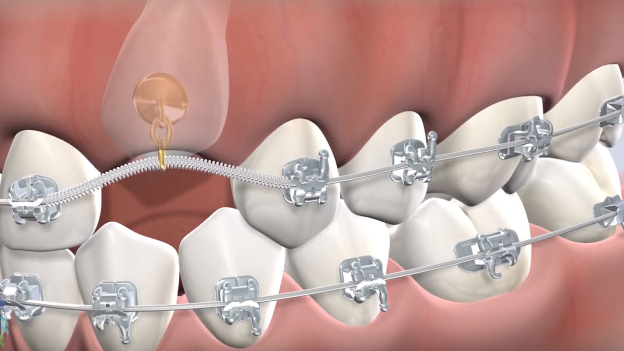Instruction  impacted tooth exposure