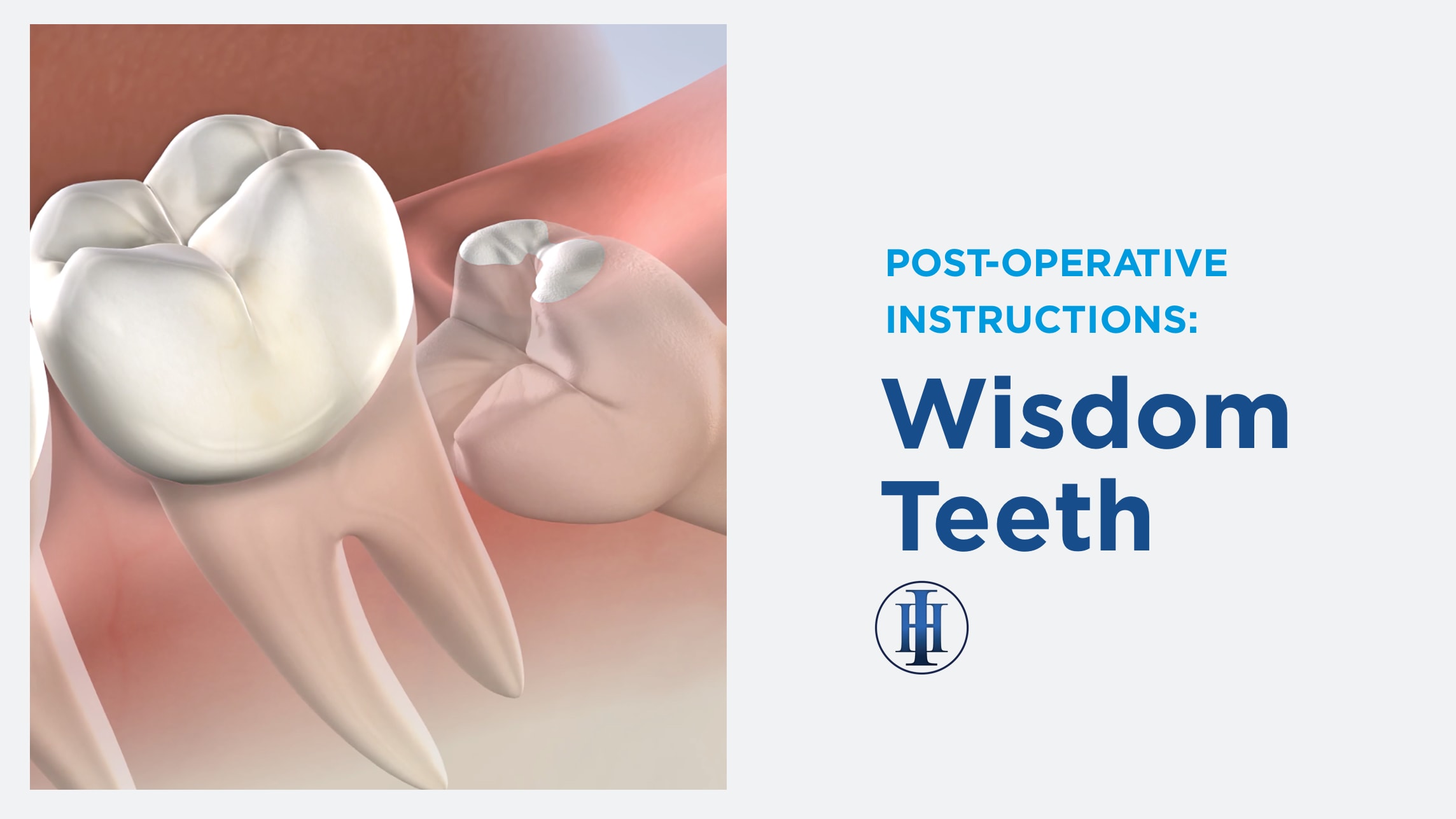 Pre op instructions wisdom teeth