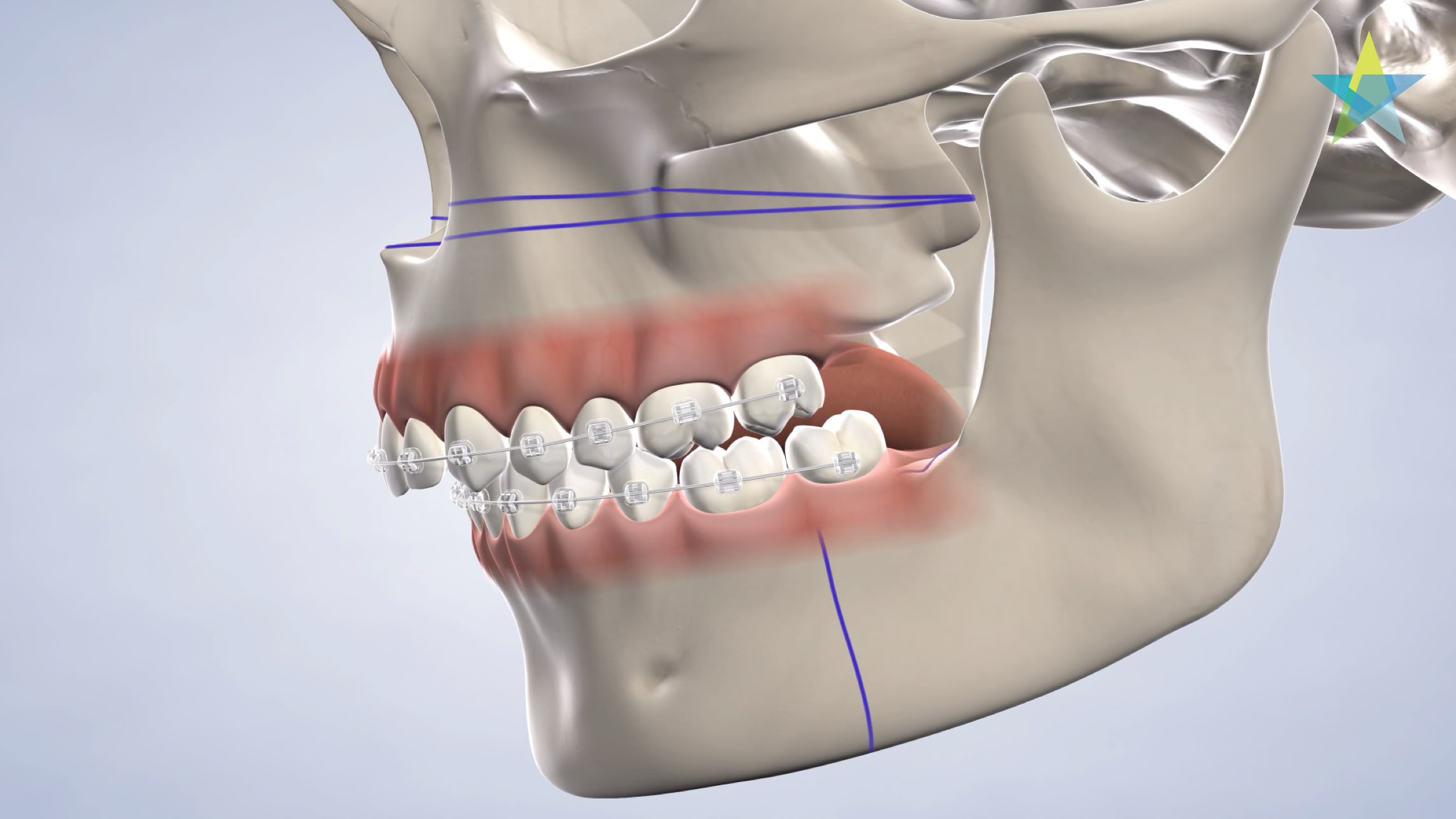 Procedure jaw surgery
