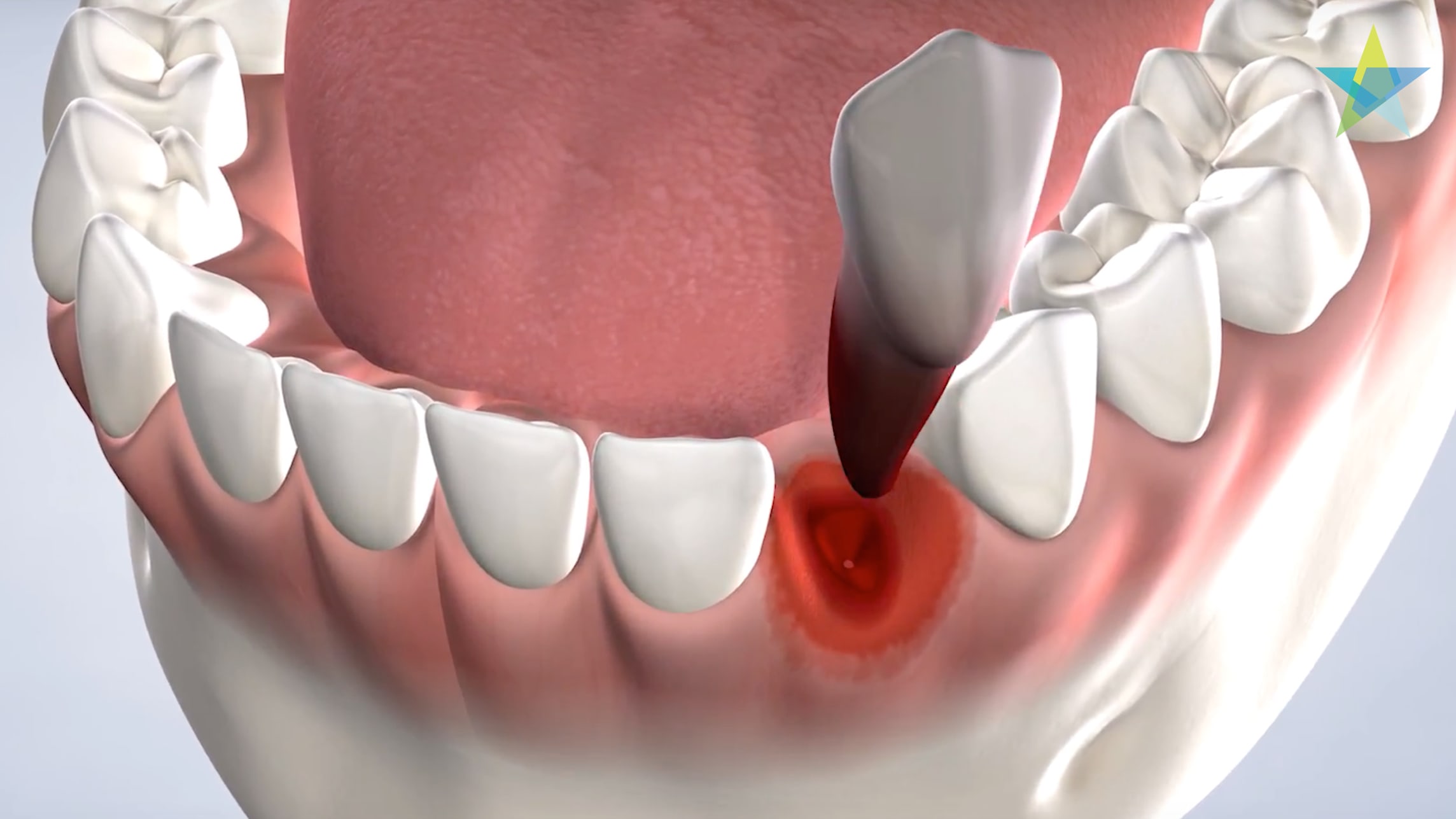 Procedure tooth extraction
